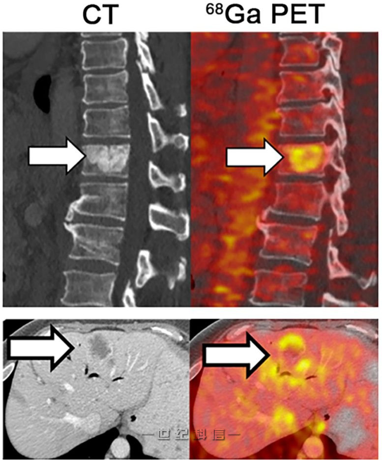 铁在转移性肿瘤中积累