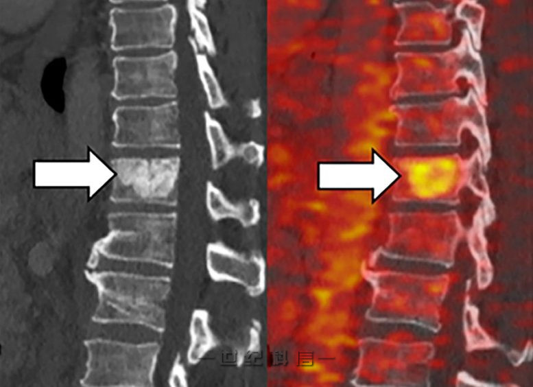 铁在转移性肿瘤作物中积累